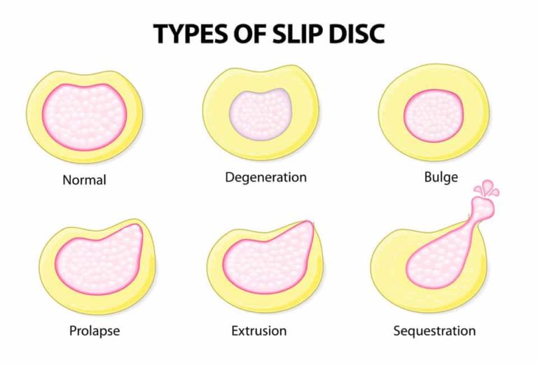 types of slipped disc