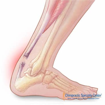 fully torn achilles tendon