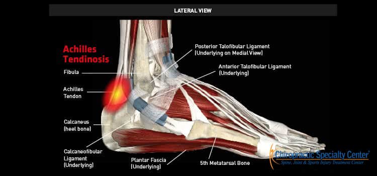Achilles tendonitis and foot soft tissues