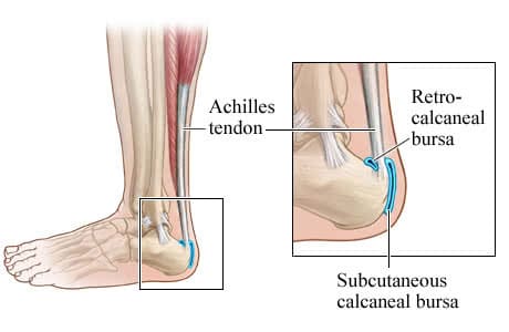 achilles bursitis and ankle joint