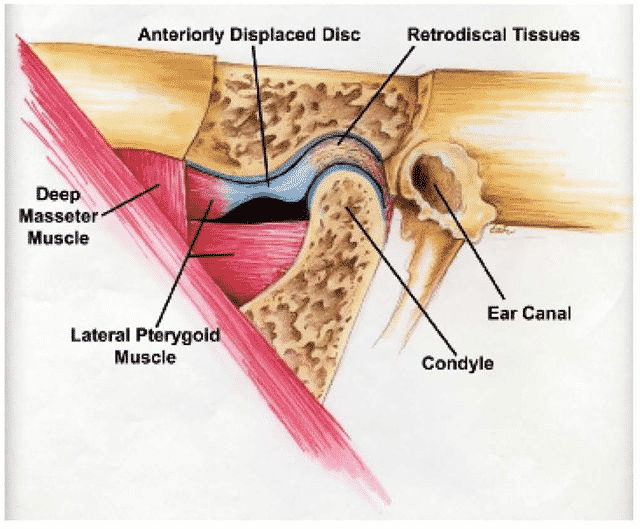 retrodiscal tissue of tmj joint and the articular disc