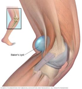 large baker's cyst