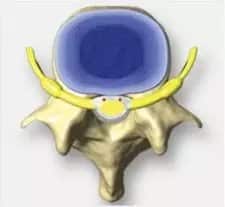 Bulging disc top view