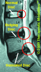 MRI showing herniated view and spinal stenosis