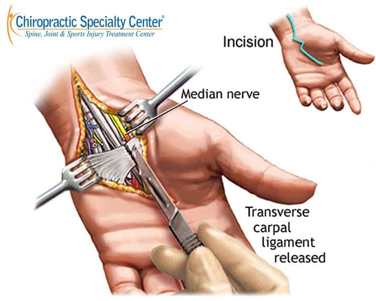 Illustration of Carpal Tunnel Surgery