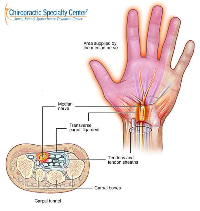 showing median nerve pain distribution with carpal tunnel syndrome