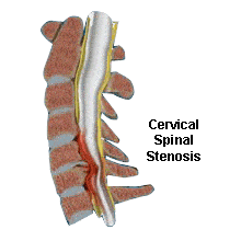 illustration of cervical stenosis (spinal stenosis in the neck)