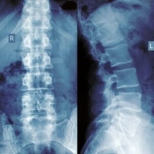Lumbar x-rays front and side view by top chiropractor in Sri Petaling, Kuala lumpur