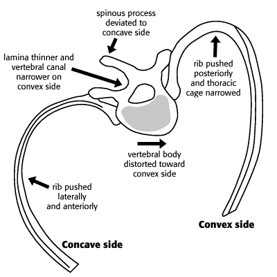 illustration showing the 3-d component of scolisis