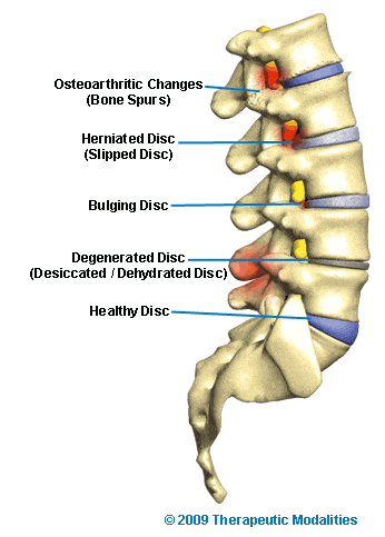 side view of spine with healthy and degenerated discs a varrious segments
