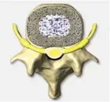 degenerated disc and desiccated disc