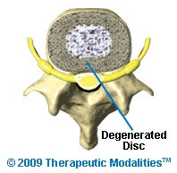 top view of a degenerated spinal disc