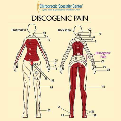Front and back body charts titled Discogenic Pain, shading the areas where pain from neck and lower back discs can be felt, with the nerve root levels C3 to S3 labeled