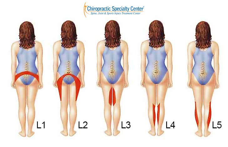 Five back views labeled L1 to L5, each shading where pain from that lumbar nerve root can be felt in the hips, thighs and legs