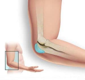 olecranon bursitis