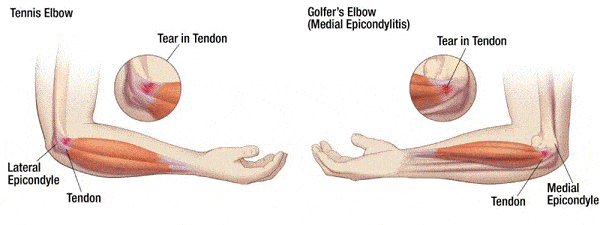 elbow pain from torn tendon shown