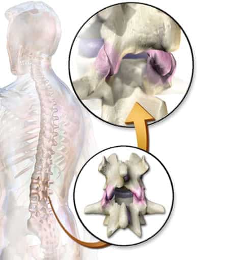 facet joints of the L4-L5 in the lumbar spine