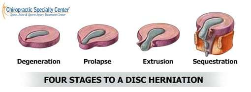 Stage of disc herniations including fragmentation (sequestration)
