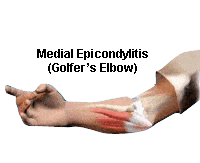 medial epicondylitis & golfer's elbow shown