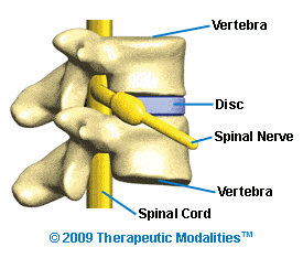 Disc Bulge Causes & Care Non-Invasively