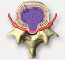 herniated disc axial view
