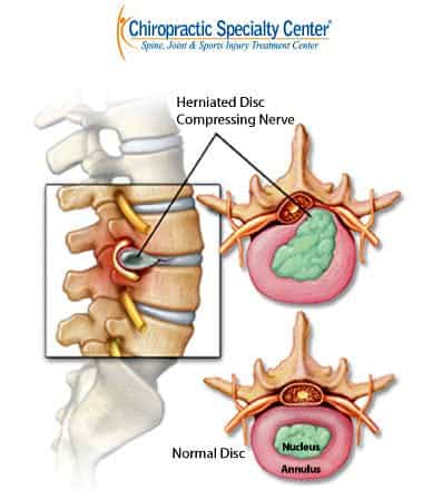 Side and top views comparing a herniated disc pressing on a spinal nerve with a normal disc, its nucleus and annulus labeled
