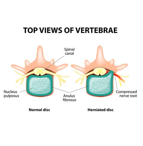 top view of herniated and normal disc for comparison