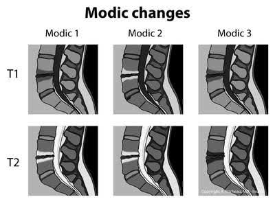 MRI images for Modic type I, II & III in T1 &T2 shown