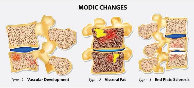 Illustration bone marrow damages in Modic type I, II & II