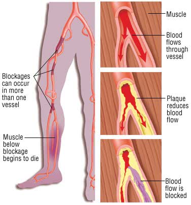 Illustration of peripheral artery disease in the leg: plaque narrowing an artery, reducing blood flow and then blocking it