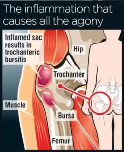 trochanteric bursitis