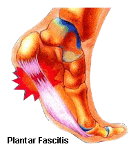 foot pain caused by heel spur and plantar fasciitis in Malaysia