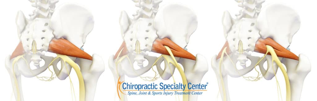 Piriformis syndrome cause of sciatica and leg pain