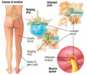 spinal causes of hip pain revealed