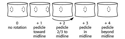 illustration showing grading method for the rotational component of scoliosis
