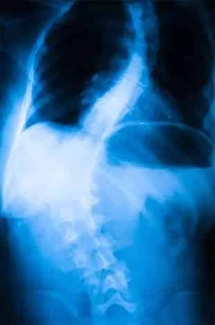 Scoliosis x-ray at chiropractic in sri petaling