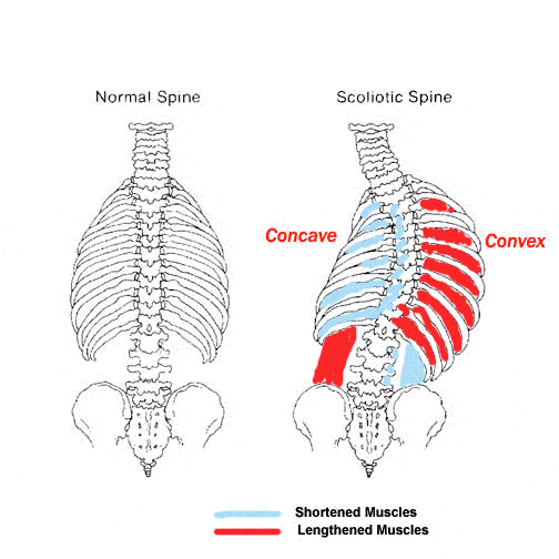 illustration showing the difference between concave & convex curves of the spine