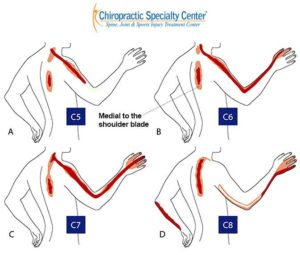 Four arm diagrams labeled C5 to C8, shading where pain from each neck nerve root can spread through the shoulder blade area, arm and hand