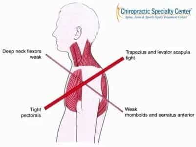 Upper Crossed Syndrome & SHoulder blade pain