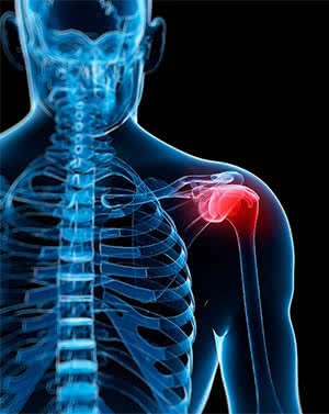 shoulder impingement shown