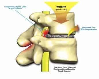 impact of axial loading on low back shown