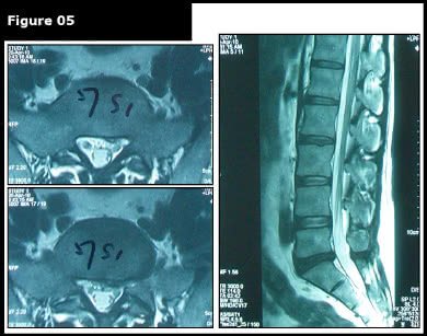 after image of proven slipped disc treatment