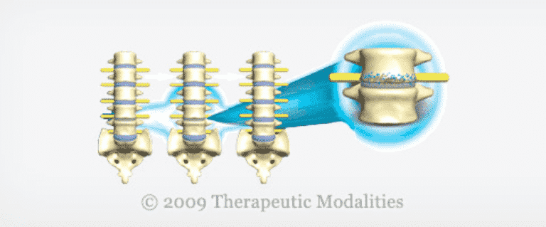illustration that shows repairs of a slip disc