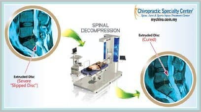 How NSD Therapy reversed a slipped disc