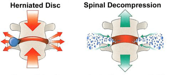 Diagram comparing a compressed, herniated disc with the same disc under spinal decompression