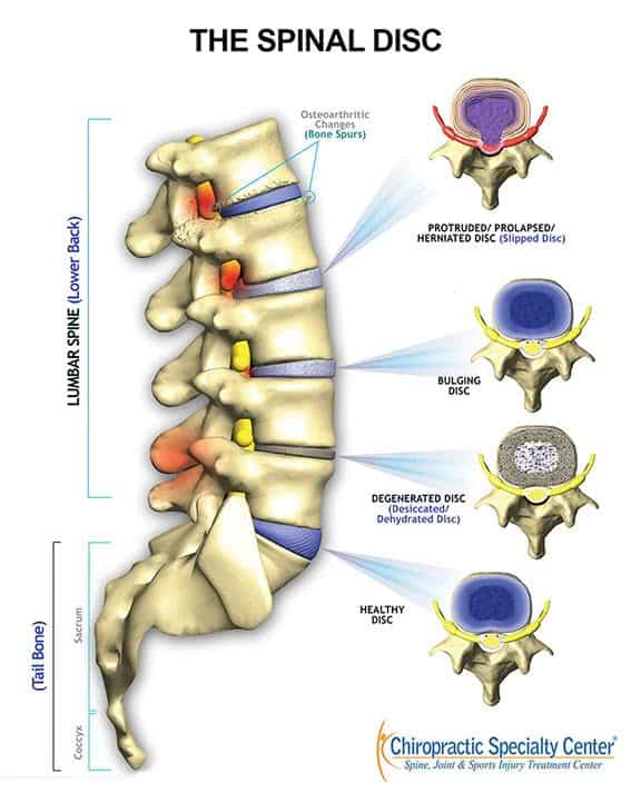 Side view of the lumbar spine with top views of a healthy disc, a degenerated (dehydrated) disc, a bulging disc and a protruded, prolapsed or herniated disc, and bone spurs from osteoarthritis