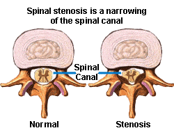 spinal stenosis shown