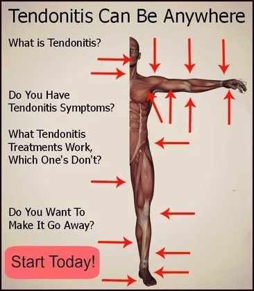 common locations for tendonitis