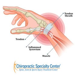 ANatomical illustration of tendons involved in de Quervain's tenosynovitis