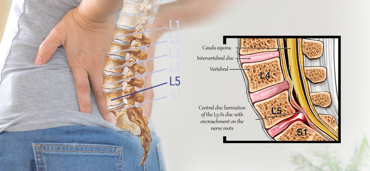L5-S1 slipped disc compressing nerve and causing back pain
